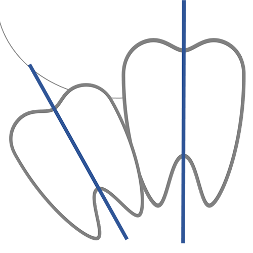 遠心傾斜埋伏智歯 - 横浜市の親知らず抜歯専門外来｜関内馬車道